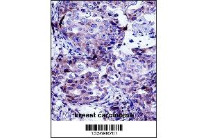 CTTN Antibody immunohistochemistry analysis in formalin fixed and paraffin embedded human breast carcinoma followed by peroxidase conjugation of the secondary antibody and DAB staining.