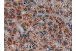 Detection of CRF in Human Liver cancer Tissue using Polyclonal Antibody to Corticotropin Releasing Factor (CRF)