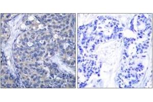 Immunohistochemistry analysis of paraffin-embedded human breast carcinoma tissue, using ZAP-70 (Ab-319) Antibody. (ZAP70 anticorps  (AA 286-335))