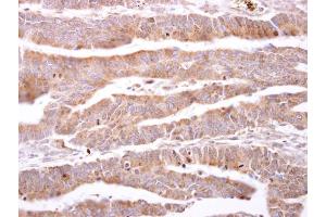 IHC-P Image ILBP antibody detects ILBP protein at cytosol on human colon carcinoma by immunohistochemical analysis. (FABP6 anticorps)