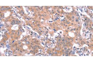 Immunohistochemistry of paraffin-embedded Human gastric cancer using GABAA Receptor alpha1 Polyclonal Antibody at dilution of 1:30 (GABRA1 anticorps)