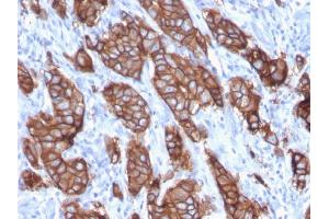 Formalin-fixed, paraffin-embedded human Breast Carcinoma stained with HER-2 Monospecific Mouse Monoclonal Antibody (ERBB2/3093). (ErbB2/Her2 anticorps  (AA 311-462))
