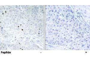 Immunohistochemistry analysis of paraffin-embedded human breast carcinoma tissue, using TP53INP2 polyclonal antibody . (TP53INP2 anticorps)