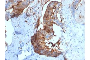 Formalin-fixed, paraffin-embedded human Renal Cell Carcinoma stained with Cathepsin D Mouse Monoclonal Antibody (CTSD/2781).