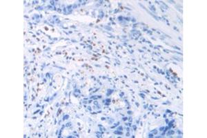IHC-P analysis of Human Rectum Cancer Tissue, with DAB staining. (MUC2 anticorps  (AA 5075-5179))