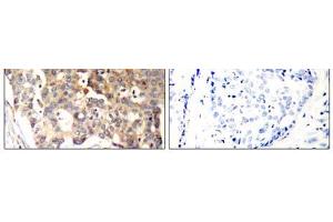 Immunohistochemical analysis of paraffin-embedded human breast carcinoma tissue, using SHP-1 (Ab-536) antibody (E021318). (SHP1 anticorps)