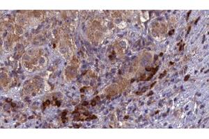 ABIN6277103 at 1/100 staining Human liver cancer tissue by IHC-P. (SPAM1 anticorps  (Internal Region))