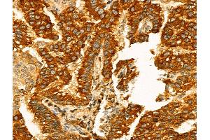 ABIN7094331 and ABIN7098378 at 1/100 staining Human lung cancer by IHC-P.