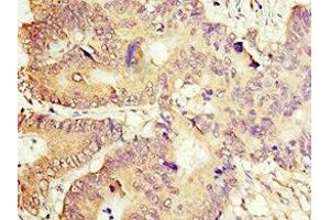 Immunohistochemistry of paraffin-embedded human colon cancer using ABIN7149378 at dilution of 1:100 (ACOT7 anticorps  (AA 151-380))
