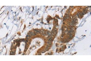 Immunohistochemistry of paraffin-embedded Human colon cancer tissue using RPS6KA2 Polyclonal Antibody at dilution 1:40 (RPS6KA2 anticorps)