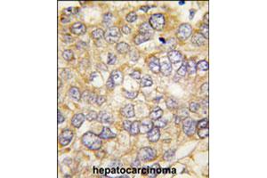 Formalin-fixed and paraffin-embedded human hepatocellular carcinoma reacted with CHRD polyclonal antibody  , which was peroxidase-conjugated to the secondary antibody, followed by DAB staining. (Chordin anticorps  (C-Term))