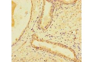 Immunohistochemistry of paraffin-embedded human prostate cancer using ABIN7171154 at dilution of 1:100 (SYT1 anticorps  (AA 301-523))