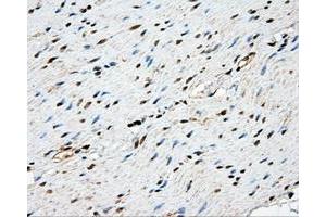 Immunohistochemical staining of paraffin-embedded Adenocarcinoma of ovary tissue using anti-NME4 mouse monoclonal antibody. (NME4 anticorps)