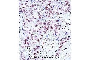 NCK1 Antibody (N-term) (ABIN657648 and ABIN2846643) immunohistochemistry analysis in formalin fixed and paraffin embedded human breast carcinoma followed by peroxidase conjugation of the secondary antibody and DAB staining. (NCK1 anticorps  (N-Term))