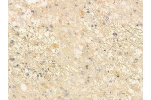 ABIN6260980 and ABIN6266518 at 1/100 staining human astrocytoma by IHC-P. (COX1 anticorps  (C-Term))