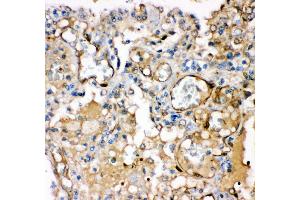 Anti- KCNMA1antibody,IHC(P) IHC(P): Human Lung Cancer Tissue (KCNMA1 anticorps  (AA 124-467))