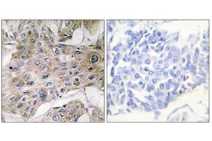 Immunohistochemistry analysis of paraffin-embedded human breast carcinoma tissue using COX7S/A2 antibody. (COX7S/A2 (N-Term) anticorps)