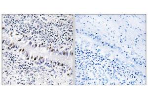 Immunohistochemistry analysis of paraffin-embedded human lung carcinoma tissue, using ZNF76 antibody. (ZNF76 anticorps  (Internal Region))