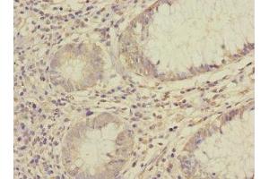 Immunohistochemistry of paraffin-embedded human colon cancer using ABIN7170966 at dilution of 1:100