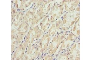 Immunohistochemistry of paraffin-embedded human gastric cancer using ABIN7151422 at dilution of 1:100 (EFHC1 anticorps  (AA 391-640))