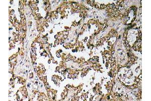 Immunohistochemical analysis of paraffin-embedded human lung cancer tissue using OR5H15 polyclonal antibody . (OR5H15 anticorps)