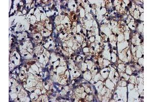 Immunohistochemical staining of paraffin-embedded Carcinoma of Human kidney tissue using anti-MGLL mouse monoclonal antibody. (MGLL anticorps)
