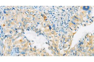 Immunohistochemistry of paraffin-embedded Human cervical cancer tissue using ARHGEF10 Polyclonal Antibody at dilution 1:45 (ARHGEF10 anticorps)