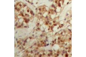 Immunohistochemical analysis of CBFB staining in human breast cancer formalin fixed paraffin embedded tissue section. (CBFB anticorps  (N-Term))