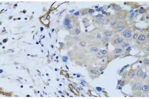 Immunohistochemistry of paraffin-embedded Human breast cancer using MCAM Polyclonal Antibody at dilution of 1:100 (40x lens). (MCAM anticorps)