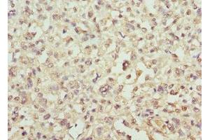 Immunohistochemistry of paraffin-embedded human melanoma using ABIN7143939 at dilution of 1:100