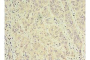 Immunohistochemistry of paraffin-embedded human liver cancer using ABIN7143935 at dilution of 1:100 (NAPA anticorps  (AA 1-295))