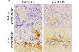 Chemotherapy upregulated periostin expression in chemoresistant triple-negative breast cancer xenografts and human TNBC patient samples.