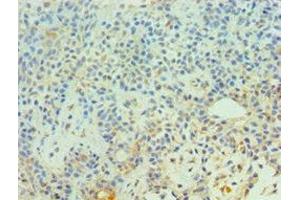 Immunohistochemistry of paraffin-embedded human breast cancer using ABIN7147302 at dilution of 1:100