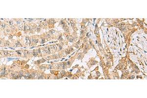 Immunohistochemistry of paraffin-embedded Human thyroid cancer tissue using HBZ Polyclonal Antibody at dilution of 1:120(x200)