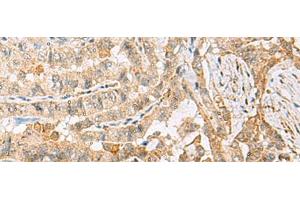 Immunohistochemistry of paraffin-embedded Human thyroid cancer tissue using HBZ Polyclonal Antibody at dilution of 1:120(x200) (HBZ anticorps)