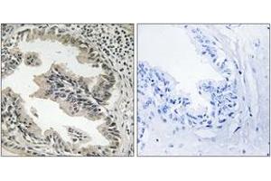 Immunohistochemistry analysis of paraffin-embedded human prostate carcinoma tissue, using SH3GLB2 Antibody.