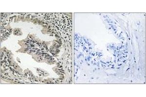 Immunohistochemistry analysis of paraffin-embedded human prostate carcinoma tissue, using SH3GLB2 Antibody.