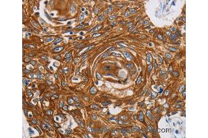 Immunohistochemistry of Human liver cancer using GRIN1 Polyclonal Antibody at dilution of 1:45 (GRIN1/NMDAR1 anticorps)