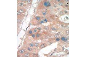 Formalin-fixed and paraffin-embedded human cancer tissue reacted with the primary antibody, which was peroxidase-conjugated to the secondary antibody, followed by DAB staining. (p21 anticorps  (C-Term))