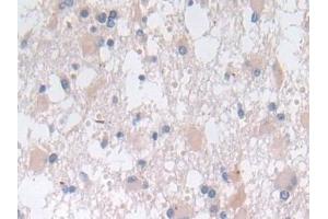 Detection of SNX13 in Human Glioma Tissue using Polyclonal Antibody to Sorting Nexin 13 (SNX13)