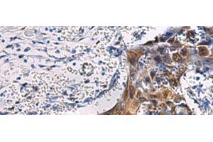 Immunohistochemistry of paraffin-embedded Human esophagus cancer tissue using SORD Polyclonal Antibody at dilution of 1:45(x200) (SORD anticorps)