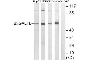 Immunohistochemistry analysis of paraffin-embedded human liver carcinoma tissue using B3GALTL antibody. (B3GALTL anticorps)