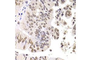 Immunohistochemistry of paraffin-embedded human colon carcinoma using SOX5 antibody at dilution of 1:100 (x400 lens). (SOX5 anticorps)