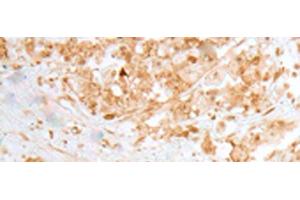 Immunohistochemistry of paraffin-embedded Human colorectal cancer tissue using MOB1B Polyclonal Antibody at dilution of 1:25(x200) (MOBKL1A anticorps)