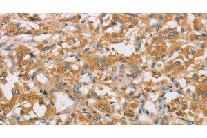 Immunohistochemistry of paraffin-embedded Human thyroid cancer using ARHGEF7 Polyclonal Antibody at dilution of 1:40 (ARHGEF7 anticorps)