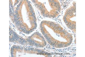 Immunohistochemistry of Human ovarian cancer using CKAP2 Polyclonal Antibody at dilution of 1:50