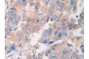 Detection of ETFb in Human Breast cancer Tissue using Polyclonal Antibody to Electron Transfer Flavoprotein Beta Polypeptide (ETFb)