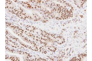 IHC-P Image Immunohistochemical analysis of paraffin-embedded PC14 xenograft, using MKRN1, antibody at 1:100 dilution. (MKRN1 anticorps)