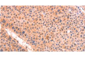 Immunohistochemistry of paraffin-embedded Human liver cancer tissue using LEP Polyclonal Antibody at dilution 1:30 (Leptin anticorps)