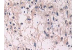 Detection of ENG in Human Glioma Tissue using Polyclonal Antibody to Endoglin (ENG)